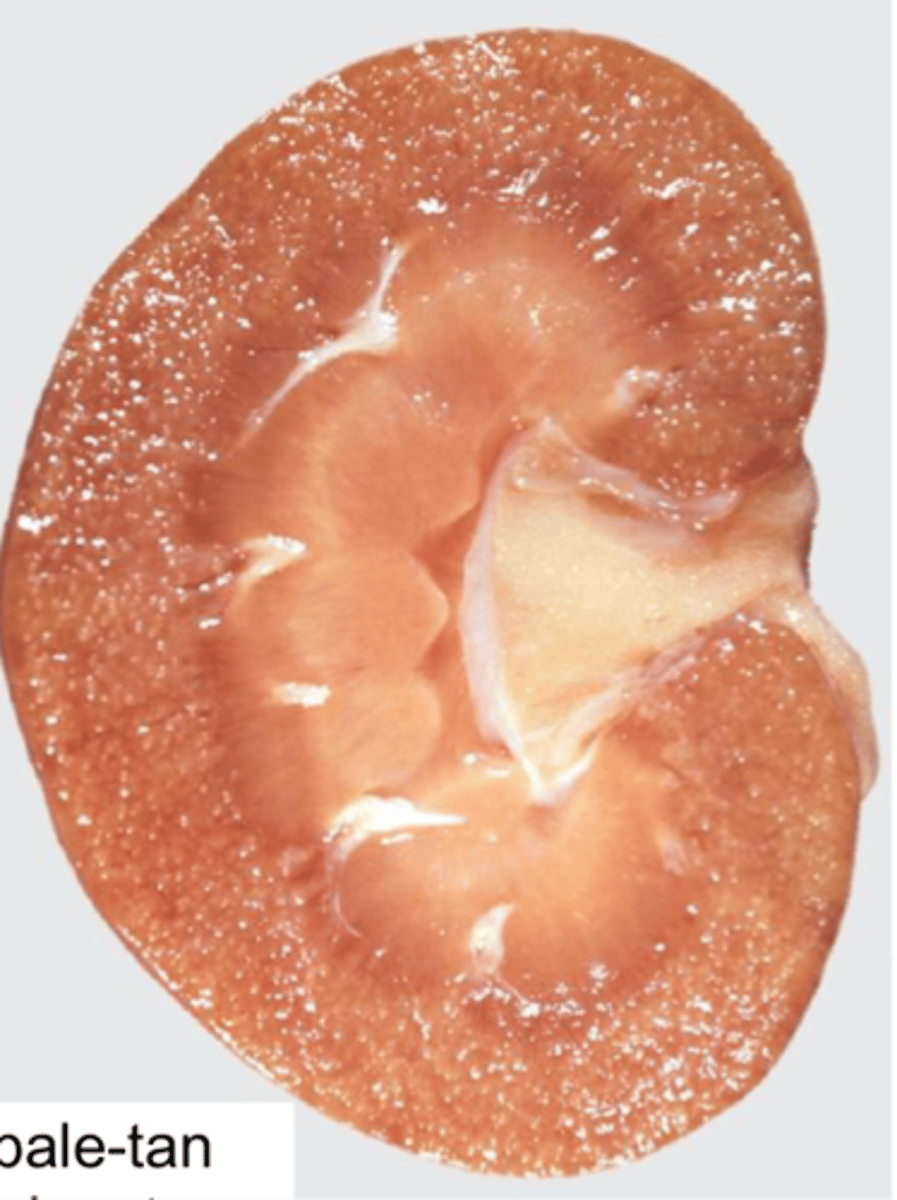 <p>Pinpoint pale/tan foci in the renal cortex</p>