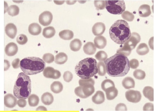 <p><span style="font-family: Helvetica; font-size: 12px;">How would you describe this peripheral blood finding?</span></p><p><span style="font-family: Helvetica; font-size: 12px;">a. Neutrophilic leukemoid reaction</span></p><p><span style="font-family: Helvetica; font-size: 12px;">b. ﻿﻿﻿Normal blood picture</span></p><p><span style="font-family: Helvetica; font-size: 12px;">c. Found with viral infections</span></p><p><span style="font-family: Helvetica; font-size: 12px;">d. ﻿﻿﻿Typical in patients with allergies</span></p>