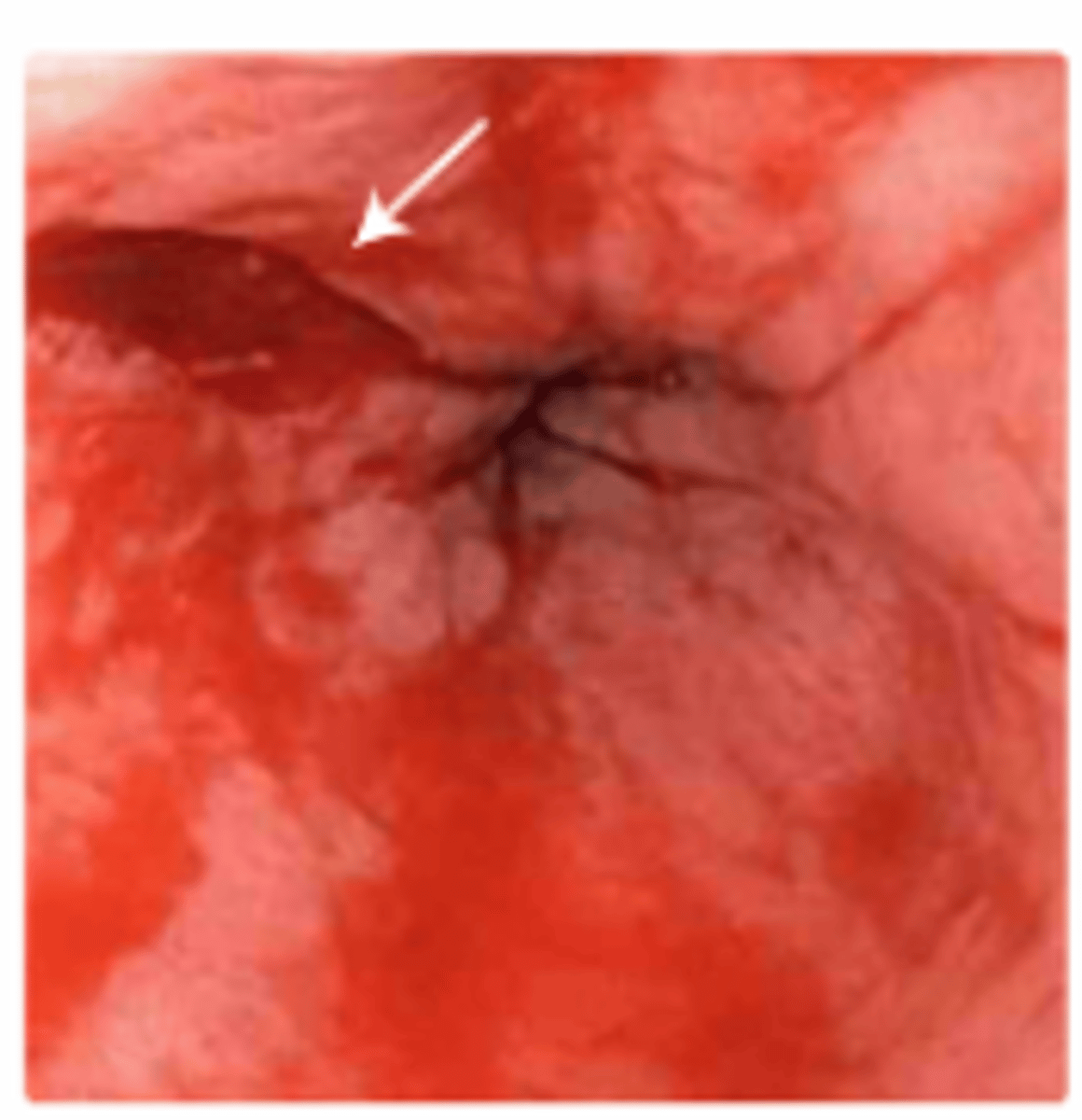 <p>RF: Alcohol Use, Hiatal Hernia, Bulimia</p><p>Dx: Suspected in patients with upper GI bleed and history of vomiting or retching</p><p>- Confirmed by upper endoscopy</p><p>PE: Acute-onset GI Bleeding (Hematemesis)</p><p>-> History of non-bloody emesis, retching, coughing prior to hematemesis</p><p>Management:</p><p>- Supportive</p><p>- Endoscopic therapy (active bleeding)</p><p>- Acid suppression (No active bleeding)</p>