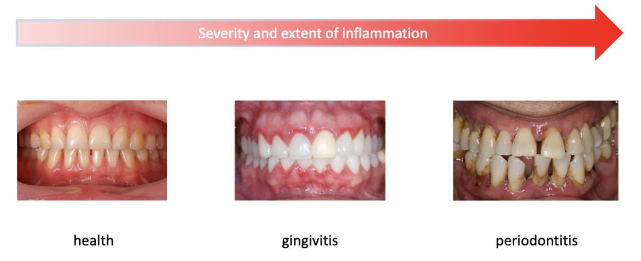 <ul><li><p>Periodontal inflammation caused by plaque bacteria</p></li><li><p>For some people only gingivitis develops, for others it progresses to periodontitis. This does not always correspond with the amount of plaque (genetics? idiopathic factors?)</p></li></ul><p></p>