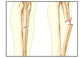 <p>What are the two types of fractures? Describe them</p>