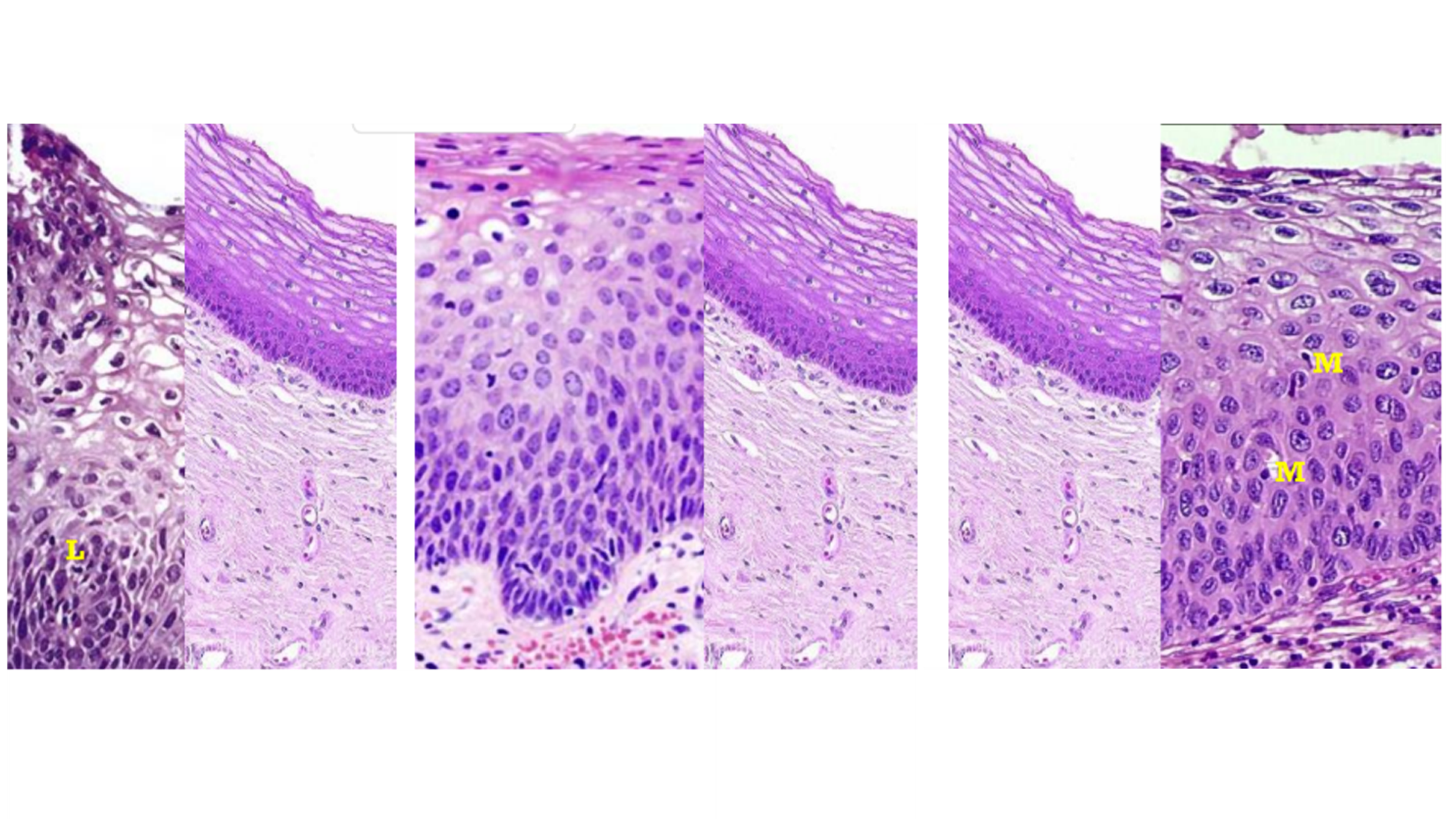 <p>Cervical Intraepithelial Neoplasia</p>