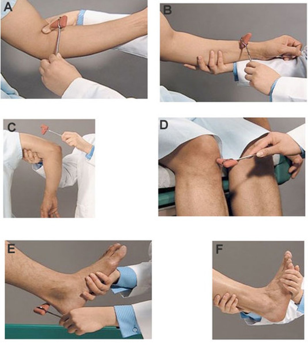 <p>aka muscle stretch reflex, myotatic reflex, monosynaptic reflex</p><p>involuntary muscle contraction in response to striking muscle tendon with reflex hammer</p><p>*results from stimulation of the stretch-sensitive IA afferent nerves of neuromuscular spindle</p><p>**produces a contraction via monosynaptic path</p>