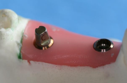 <p>What are some concerns regarding tissue level implants?</p>