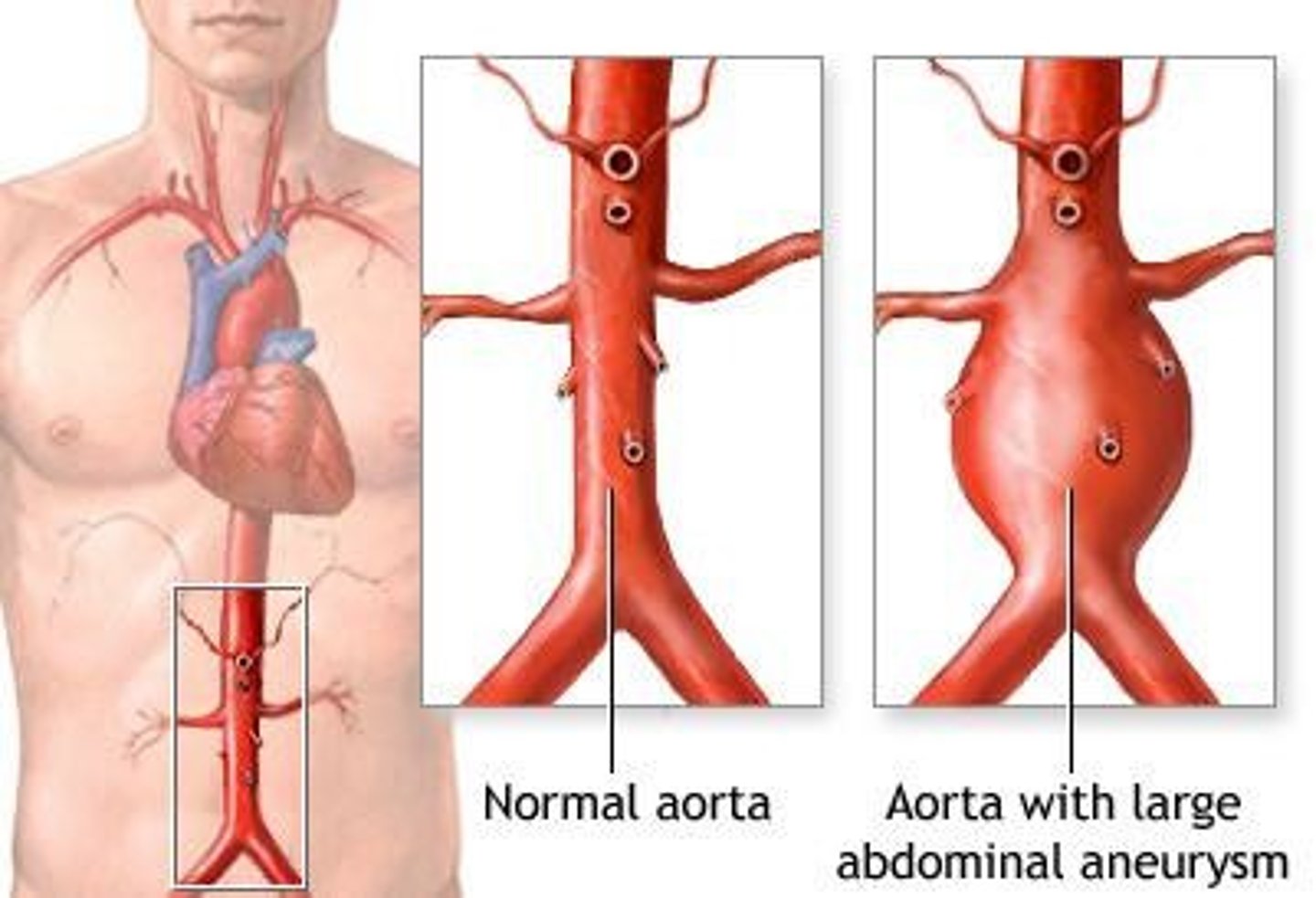 <p>Weakening of aorta's layers, potentially leading to rupture.</p>