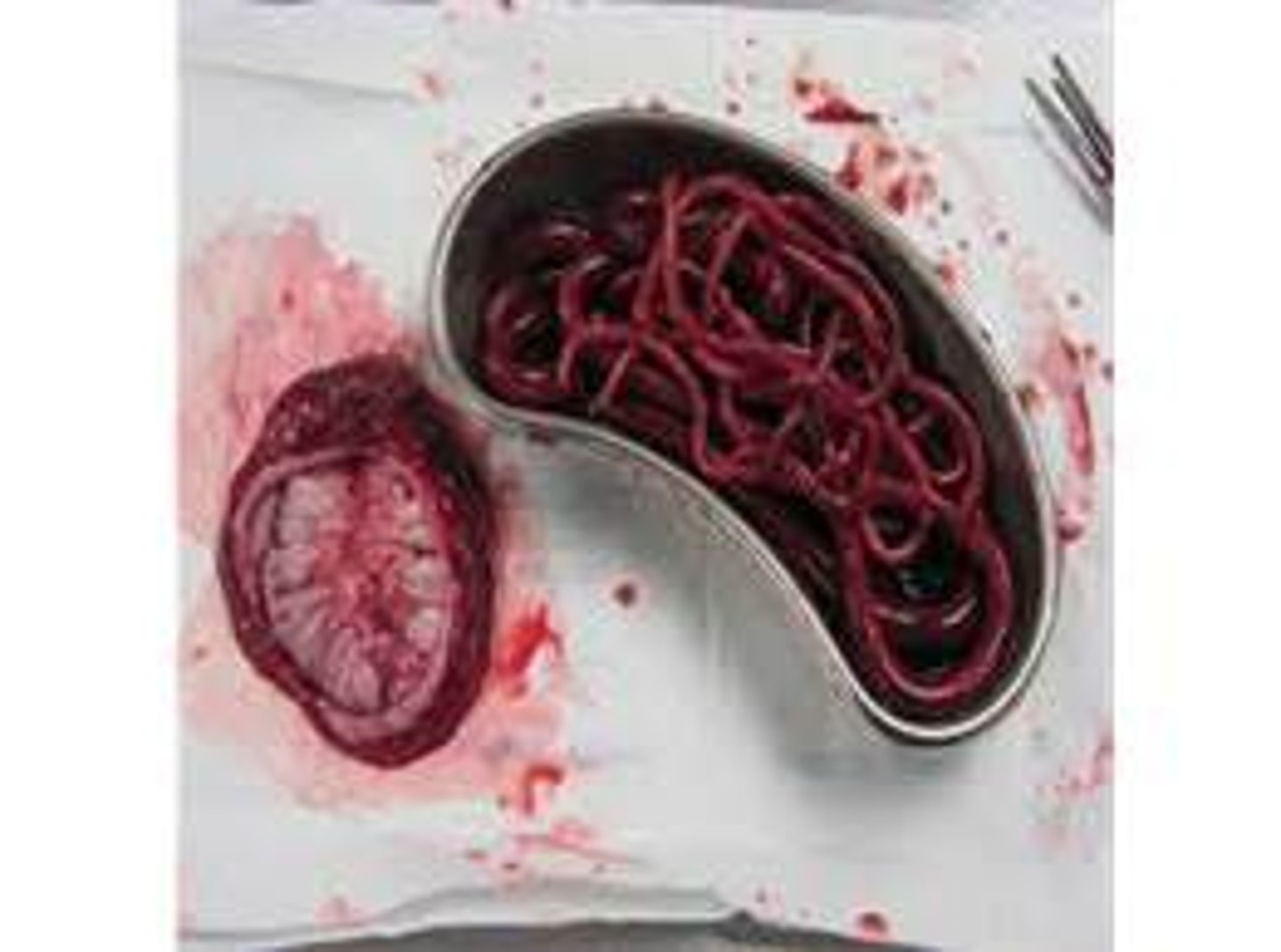 <p>Giant kidney worm</p>
