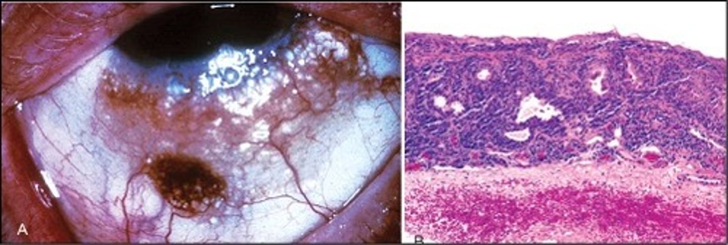 <p>Information for Condition:</p><p>Circumscribed growth in conjunctiva</p><p>Small cells w/ cystic glands</p>