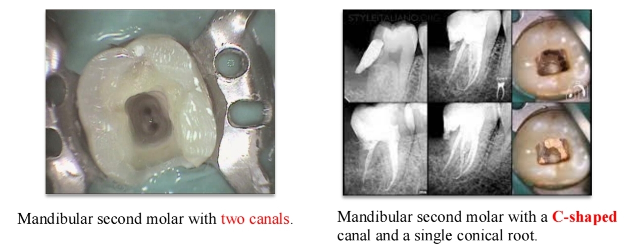 <p><strong>3rd root</strong></p><p class="has-focus"><strong>One conical root</strong> with one conical canal</p><p class="has-focus">C shaped canal</p>