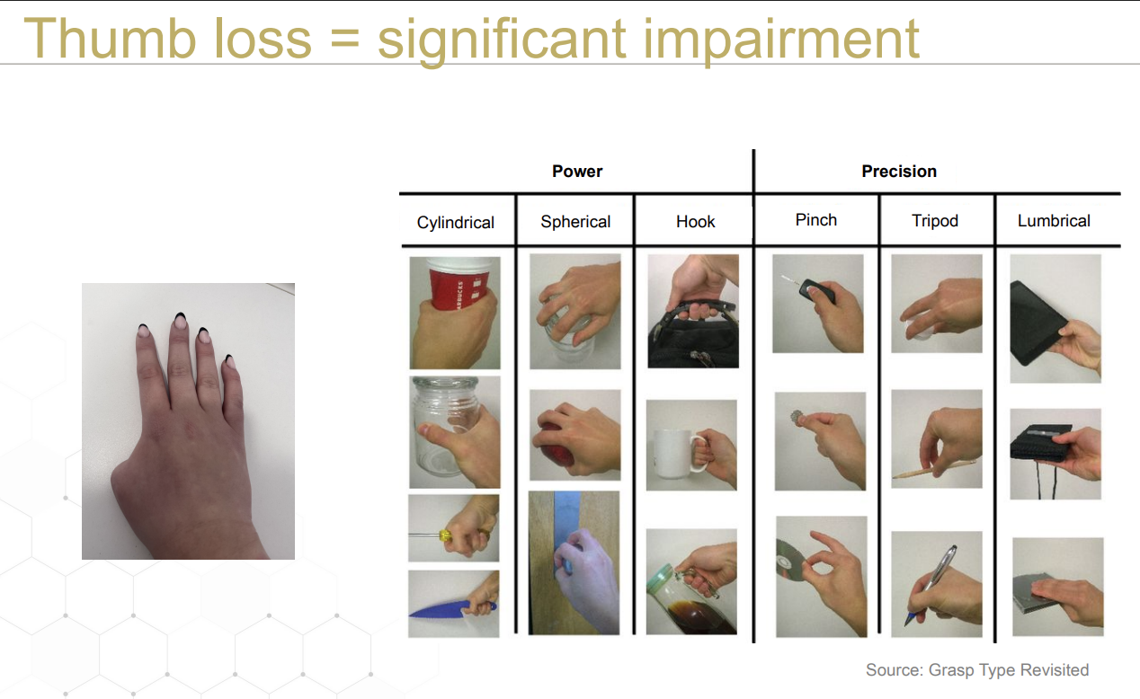 <p>40% loss of hand function</p><p>—&gt; 36% loss of upper limb function</p><p>—&gt; —&gt; 22% whole person impairment</p>