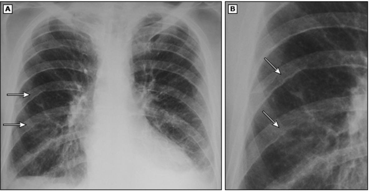 <p>3 y/o Patient presents to the ER for syncope. Mother reports that he hasn’t eating well and gets tired very easily. On a physical you note a brachial-femoral pulse delay, upper extremity HTN, prominent neck pulsations, and corkscrew tortuosity of retinal arteries. What diagnostic tests do you want to order?</p>