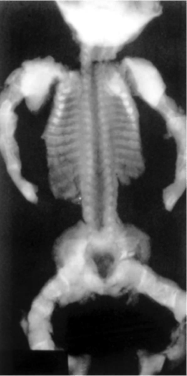 <p>3 definitions of fetal shortened long bones: biparietal diameter (BPD) to femur or humerus length (FL, HL) ratio of greater than 1.5 standard deviations above the mean for gestational age; observed to expected (O/E) femur and humerus length ratio of <0.92 and <0.90, respectively; femur and/or humerus length less than the fifth percentile for gestational age.</p>