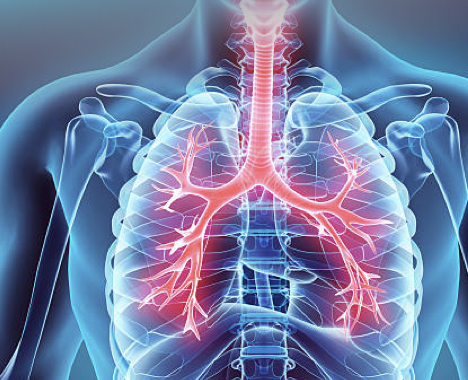 <ul><li><p>Viral: “PAIR”</p><ul><li><p><strong>p</strong>arainfluenza, <strong>a</strong>dvenovirus, <strong>i</strong>nfluenza, <strong>r</strong>hinovirus </p></li></ul></li><li><p>Bacterial</p><ul><li><p>strep, pneumonea, haemophilus influenza (more likely COPD and smokers</p></li></ul></li><li><p>SM</p><ul><li><p>initially dry cough with mucoid sputum </p></li><li><p>as progresses, dyspnea, stridor, wheezes, purulent sputum </p></li></ul></li></ul><p></p>