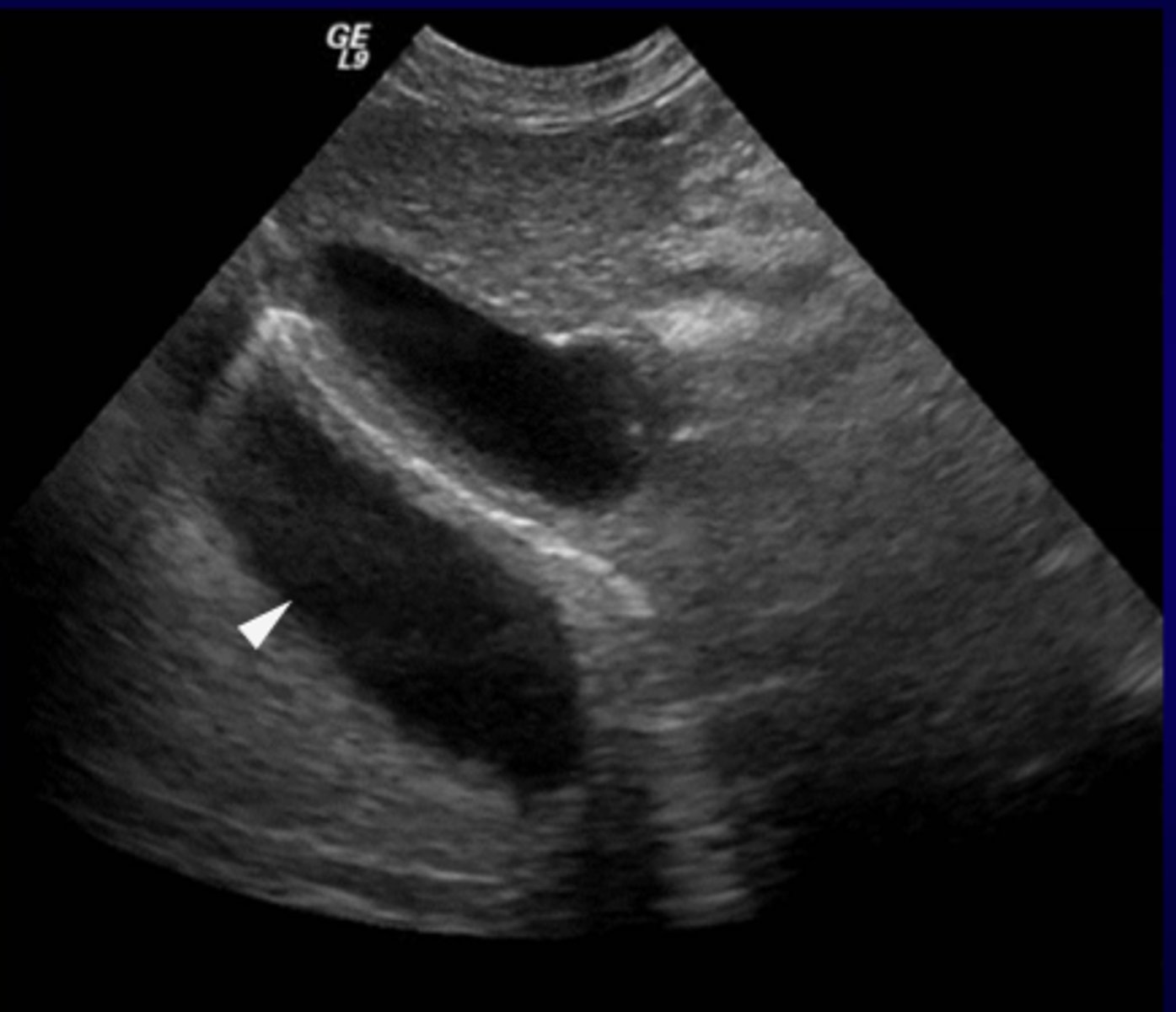 <p>What ultrasound artifact causes the <strong>duplication of image of the opposite side of a strong reflector</strong>?</p>