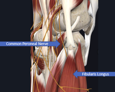 <ul><li><p>may be seen w/ knee or fibular fx’s, also assoc with crossing legs while seated</p></li><li><p>sx: parasthesias of lat lower leg/dorsum of foot, may have painful dysesthesia</p></li><li><p>signs: weakness of dorsiflexors, + tinnel’s at some point along nerve course (ex tarsal tunnel), may have prolonged NCV on EMG</p></li><li><p>tx: OMM for fib head, surgical decompression</p></li><li><p>ddx: must differentiate from L5 radiculopathy, consider diabetic neuropathy if “painless footdrop” </p></li></ul><p></p>