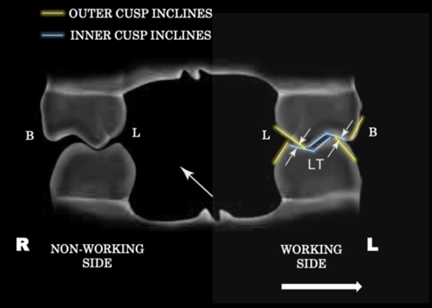 <p>Outer inclines of our maxillary lingual cusps against inner incline mandibular lingual cusps</p><p>and/or</p><p>Inner incline of maxillary buccal cusps against outer incline of mandibular buccal cusps</p>