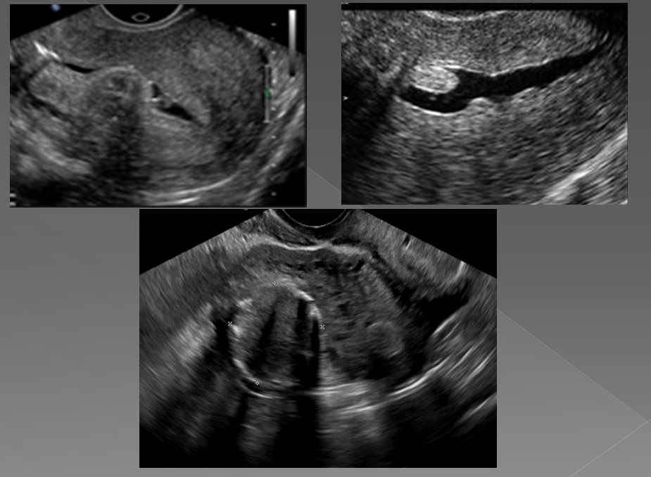 <p>Submucosal leiomyomas can disrupt the _______, causing ______, or ______ bleeding and _______</p>