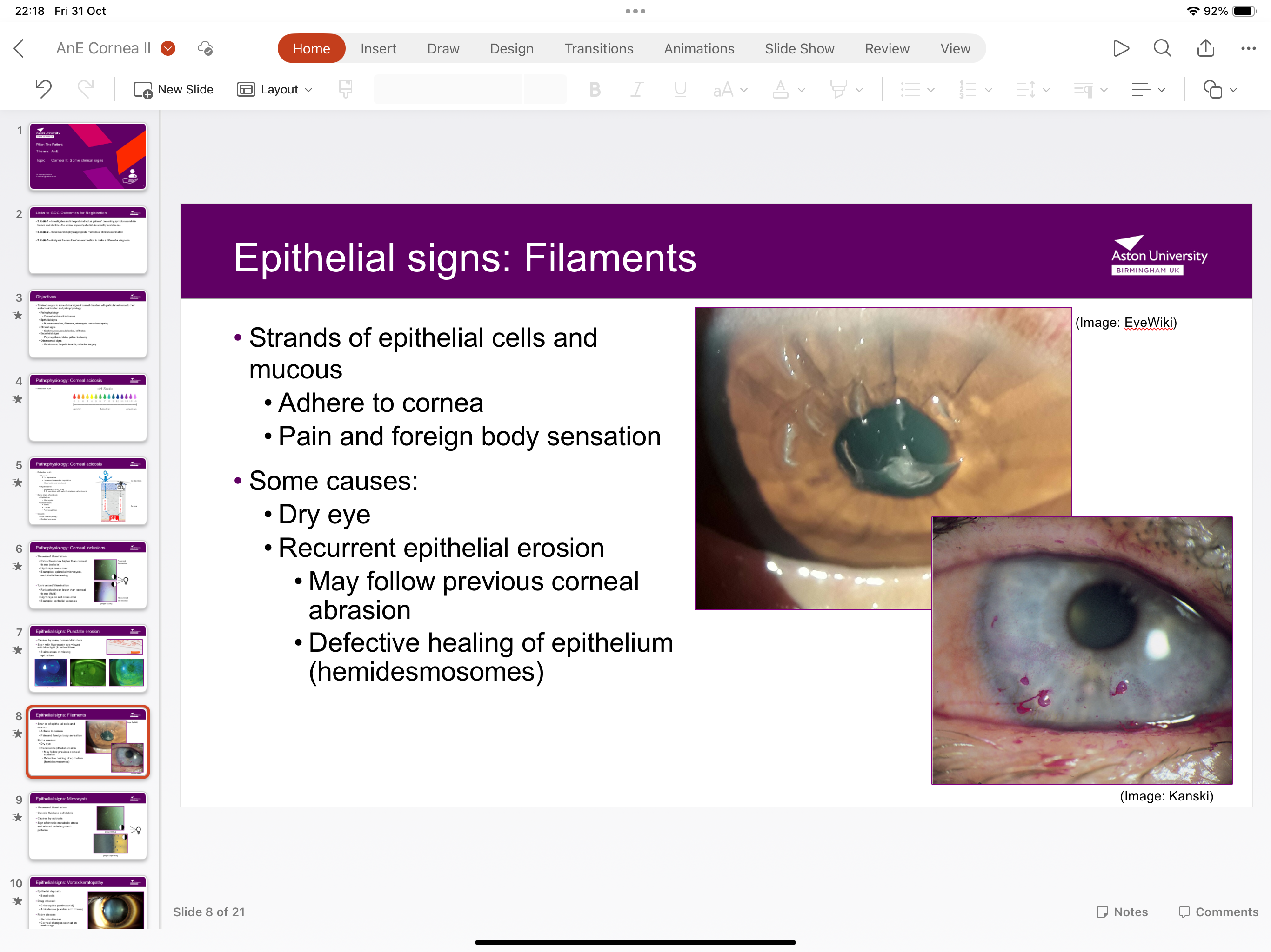 <p>Strands of epithelial cells and mucus high adhere to cornea causing pain caused by dry eye, recurrent epithelial erosion</p>