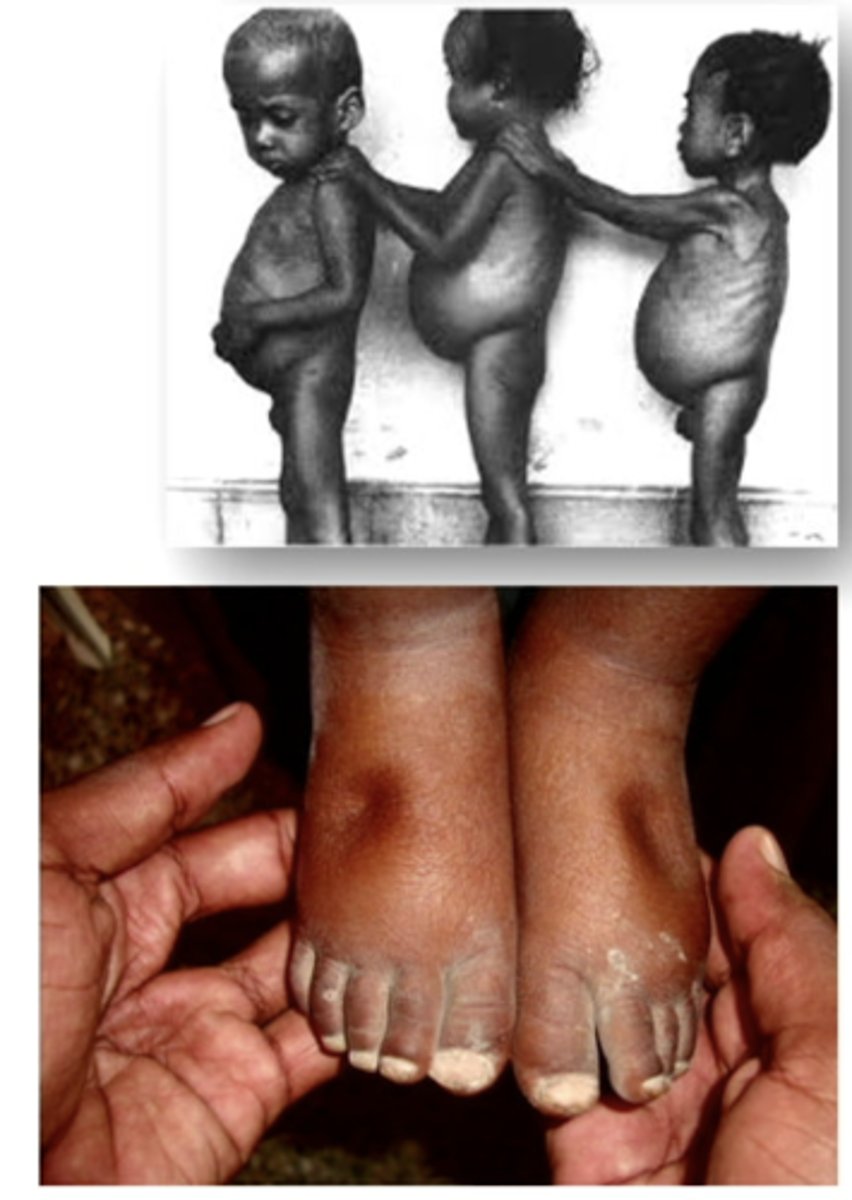 <p>may be caused by decreased plasma protein synthesis (liver disease), glomerular diseases, drainage from large, open wounds</p><p>tends to produce generalized edema rather than dependent edema. swelling in face, legs, and feet</p><p>potential causes:</p><p>1. increased loss of plasma proteins</p><p>2. protein losing kidney diseases</p><p>3. extensive burns</p><p>4. decreased production of plasma proteins</p><p>5. liver disease</p><p>6. starvation, malnutrition</p>