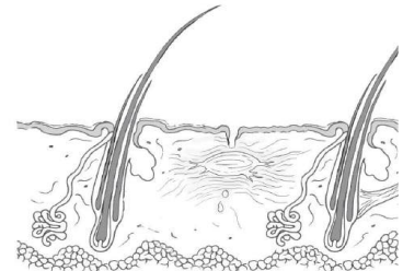 <p>Área de tejido fibroso que reemplaza los componentes de la epidermis, dermis y anexos.</p><p>Secundaria a inflamaciones severas y traumatismos</p>