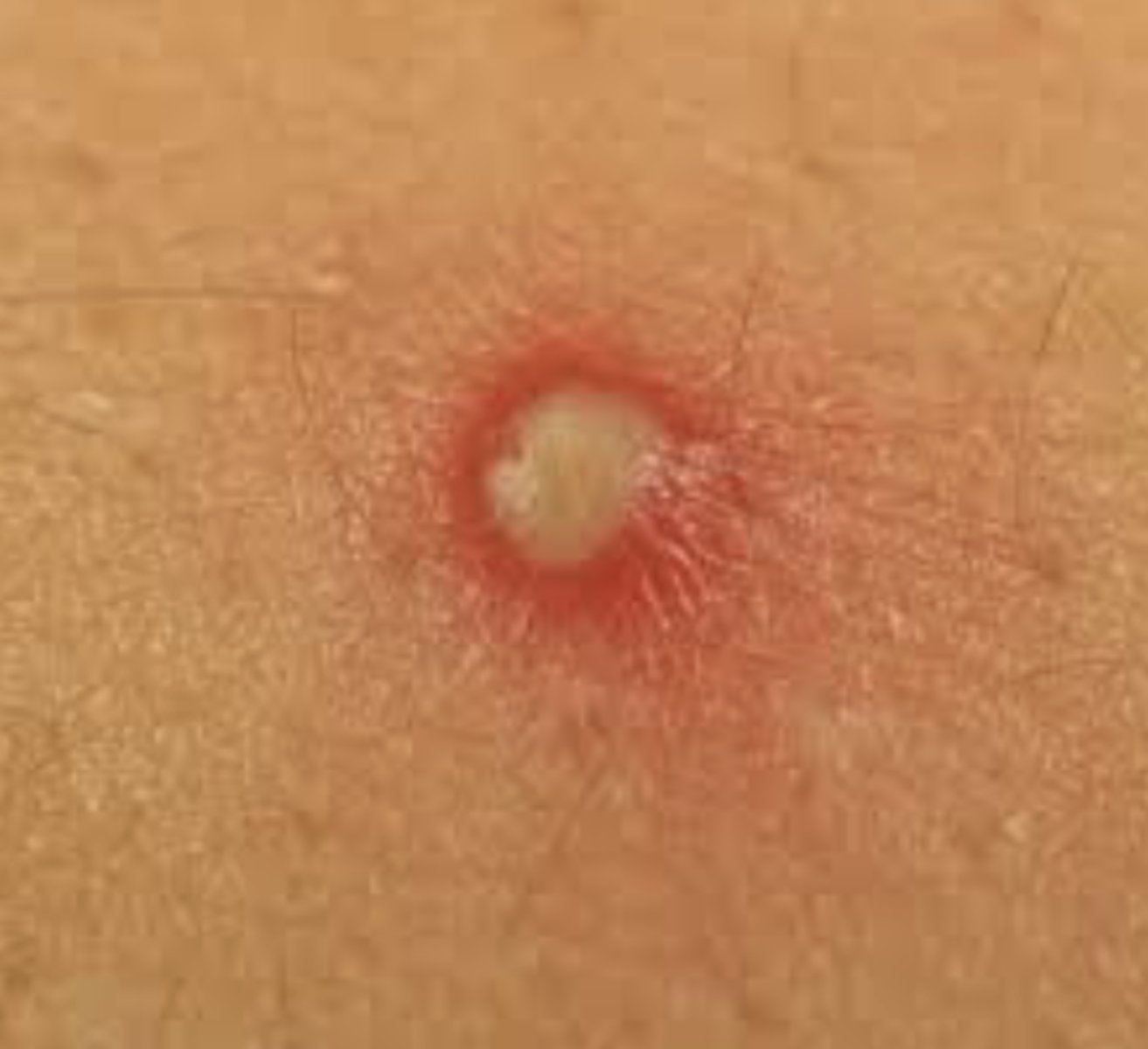 <p>A papule with a pus filled center</p>