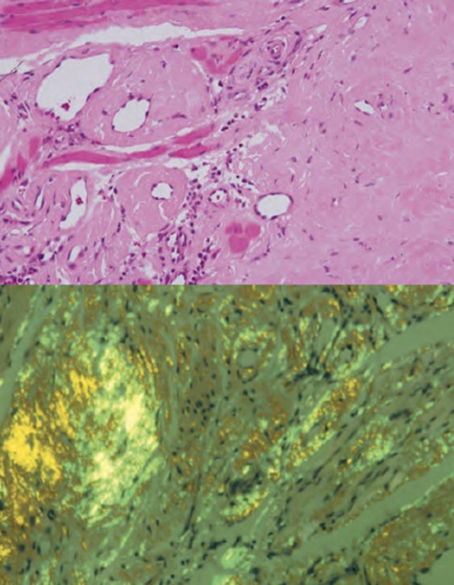<p>-extracellular deposition in the submucosal CT of an amorphous, eosinophilic material</p><p>-stains positively for congo red and appears apple-green on birefringence</p>