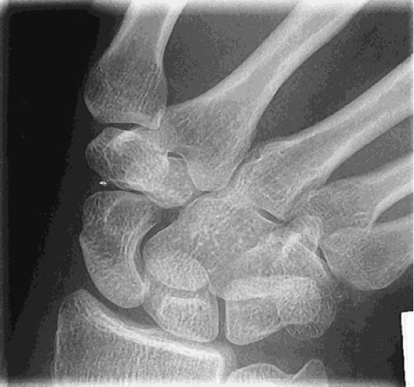 <p><span style="line-height: normal;"> </span>Scaphoid clearly seen without superimposition</p><ul><li><p class="p1">10° to 15° CR angle (elongates scaphoid)</p></li></ul><p class="p1"><span style="line-height: normal;"> </span>Scaphoid fat stripe demonstrated</p><p class="p1"><span style="line-height: normal;"> </span>1<span style="line-height: normal;">st</span> metacarpal is aligned with the long axis of the forearm</p><ul><li><p class="p1"><span style="line-height: normal;">&nbsp;</span>Indicates proper ulnar deviation</p></li></ul><p></p>