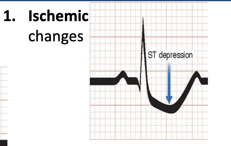 <p>Ischemic changes</p>