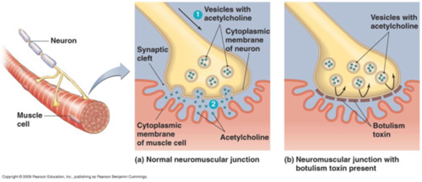 <p>neurotoxin produced by the bacteria clostridium bacterium; prevents fusion of acetylcholine to the cell membrane and leads to paralysis of muscles</p>