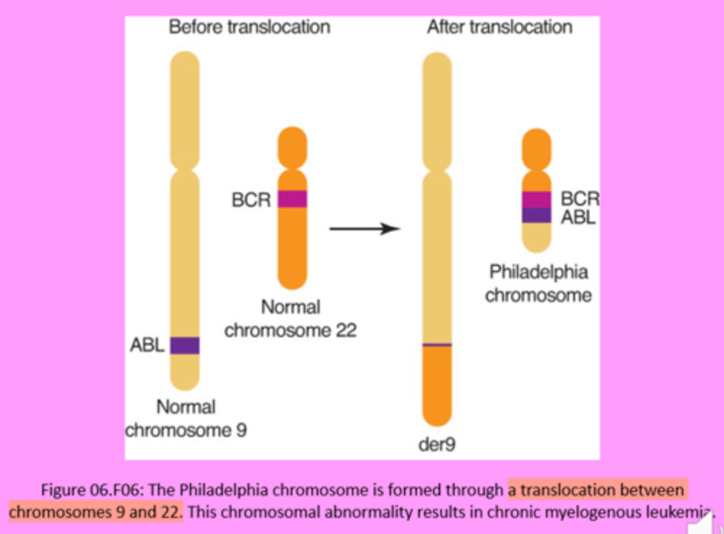 <p>A translocation between chromosomes 9 and 22, known as the Philadelphia chromosome, fuses the BCR and ABL genes, leading to overactivation of the BCR-Abl protein kinase in CML.</p>