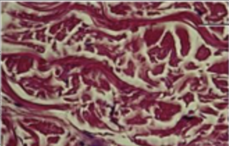 <p>little ground substance, dense network of randomly interwoven collagen fibres and extracellular proteins, few fibroblasts</p>