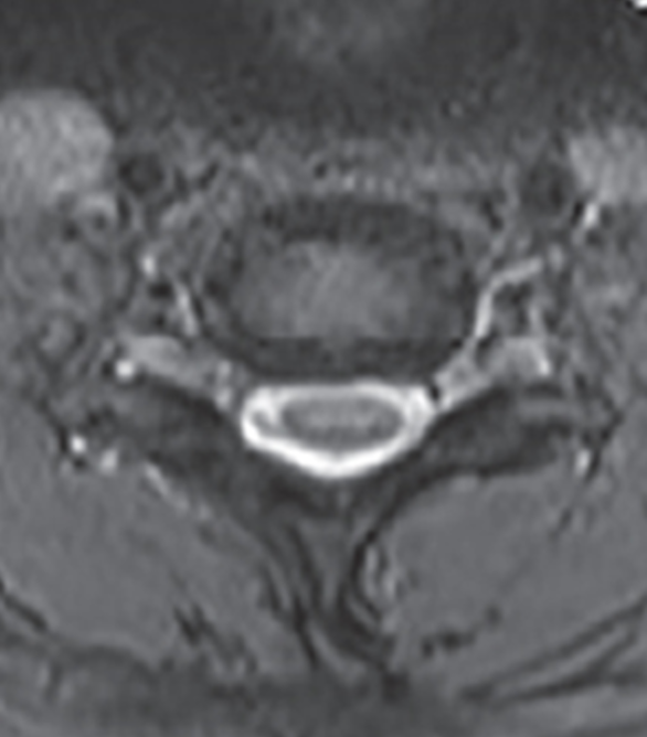 <p>Displacement of the outer fibers of the annulus beyond the margins of the endplate</p><p>Involves more than 25% of the circumference of the intervertebral disc</p>