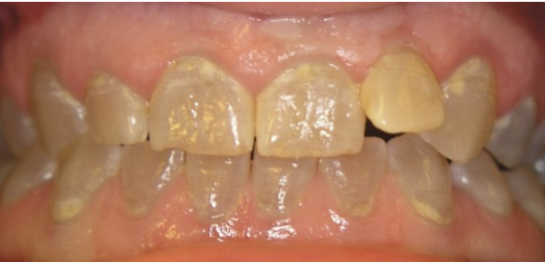 <p>Hierbij is er sneller last &nbsp;van glazuur verlies doordat er een afwijking is aan de dentine. De verbinding tussen het dentine en glazuur is zwakker waardoor het glazuur sneller loslaat. Deze patiënten krijgen niet sneller cariës dan elementen met normale situatie. De mondhygiëne is wel lastiger, door een hobbelig oppervlakte. Dentinegenesis imperfecta is abrasie gevoelig. Vaak hebben ze een afwijkende kleur. Gelukkig heeft het geen verhoogde cariës gevoeligheid. Op een röntgenfoto is vaak een korte radices. Ook zijn er vaak wortelfracturen en zijn het wortelkanaal en de pulpakamer vroeg geoblitereerd.</p>