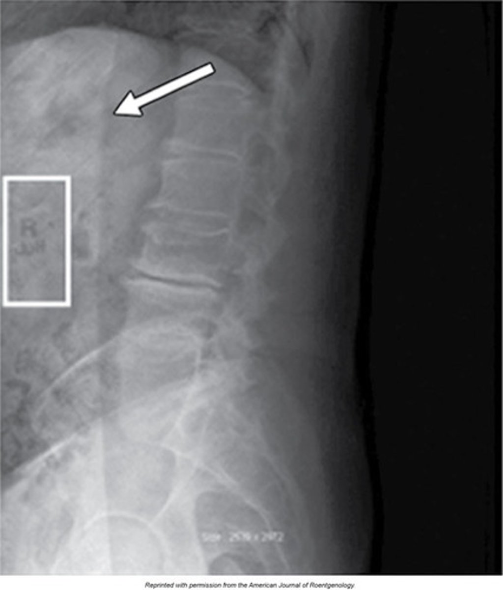 <p>For example, in an offset correction was performed after an examination was done with a right-side marker in an area of unattenuated radiation. Residual signal remained in that area and a subsequent offset correction was performed. The R is now viewed inversely because that signal created a mask during the offset correction. In Fig. 5.10 it is clear that the signal is still very strong and this image was taken 10 minutes after the initial exposure.</p>