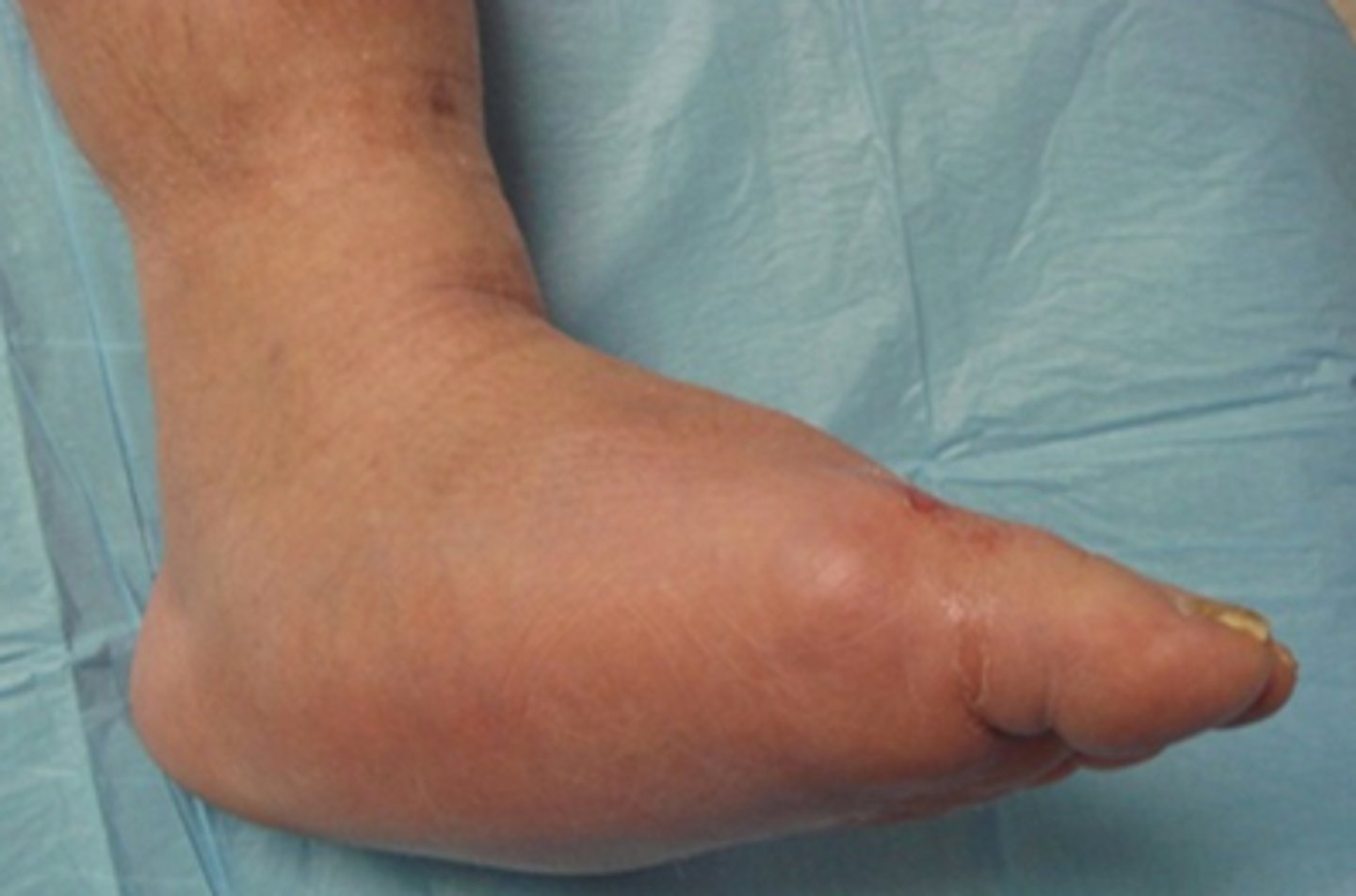 <p>repeat injury to the food that is not allowed to heal - no infection is present</p>