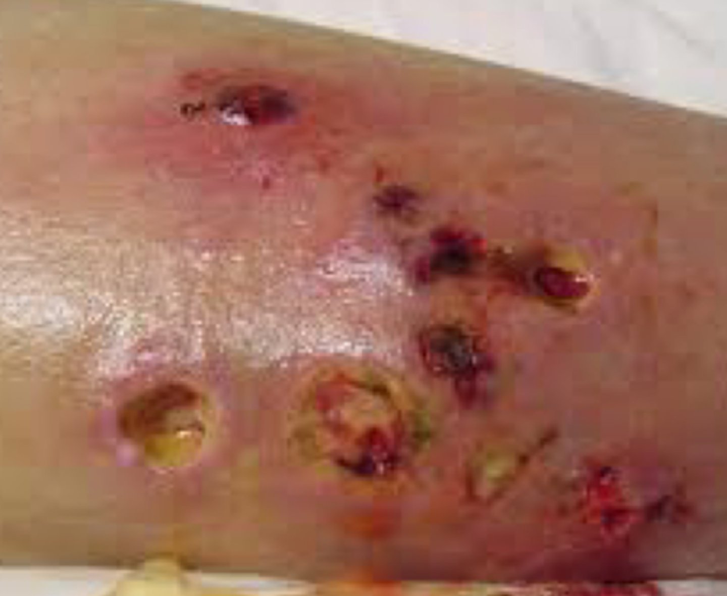 <p>What caused this rash?</p>