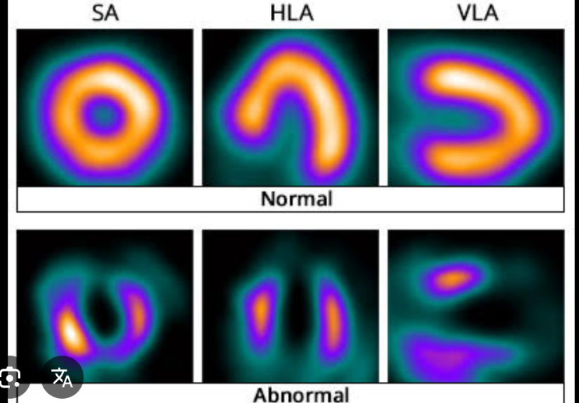<p>combines the parenteral administration of thallium Tl 201, a radionuclide taken up by healthy myocardial tissue, and the stress test (either exercise or pharmacologic). A gamma camera is used to record serial images of the myocardium</p>
