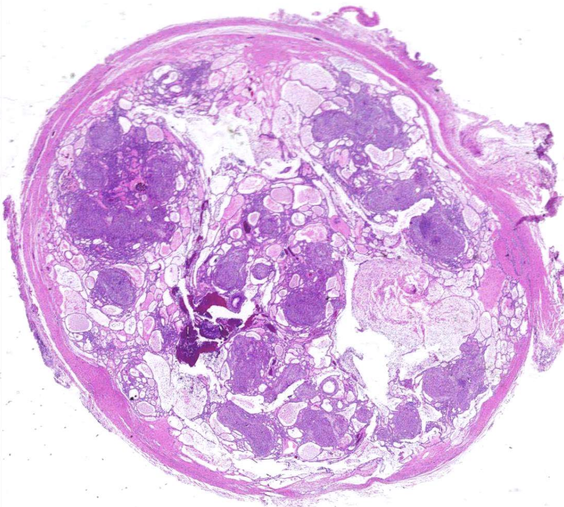 <p>what are histopathologic features of Adenomatoid Odontogenic Tumor?</p>