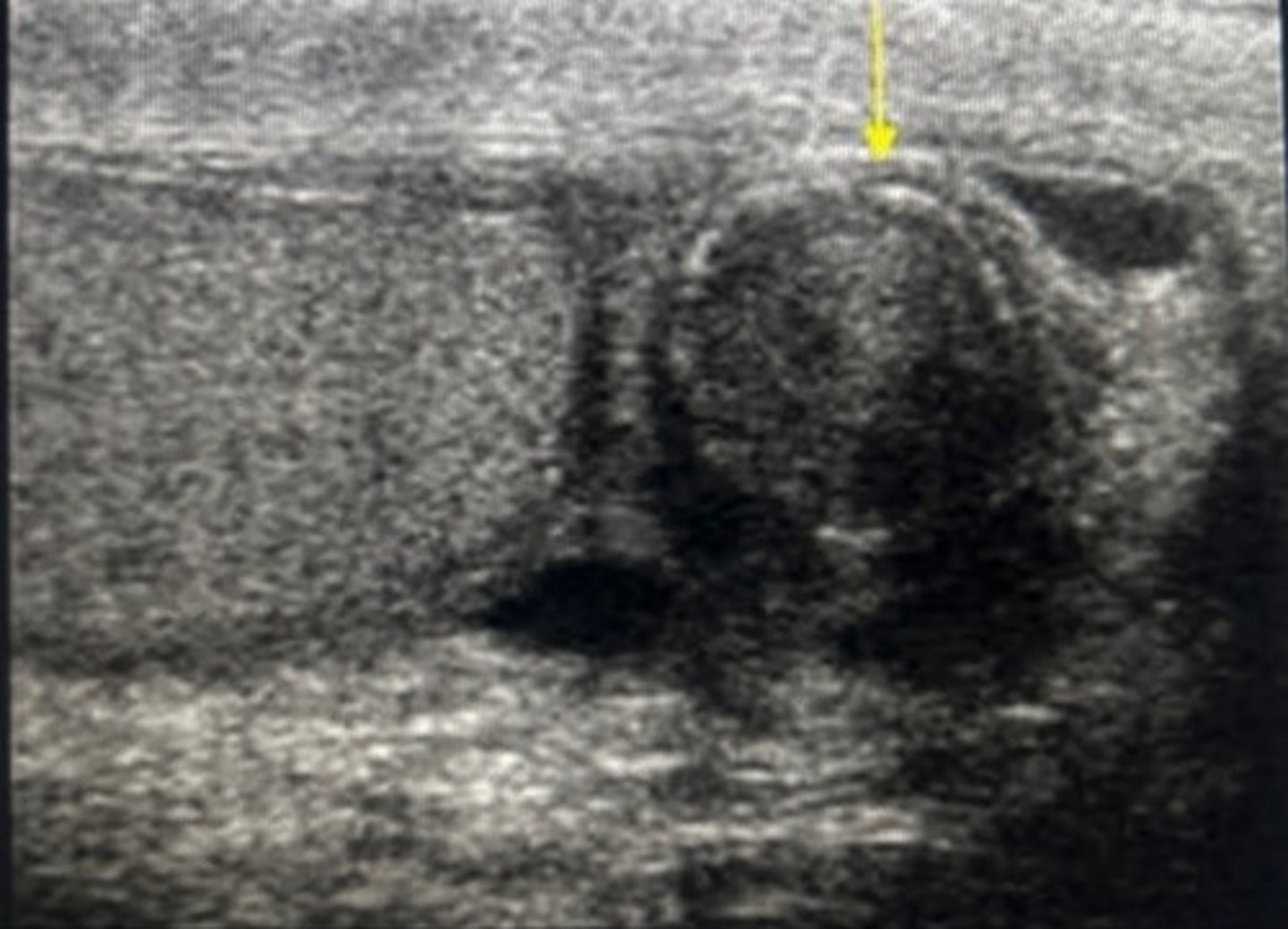 <p>vasectomy</p>