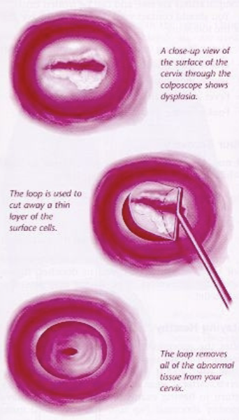 <ul><li><p>uses a thin, low-voltage electrified wire loop to cut out abnormal tissue</p></li><li><p>cut away abnormal cervical tissue  that can be seen during colposcopy</p></li><li><p>remove abnormal tissue high in the cervical canal that cannot be seen during colposcopy</p></li></ul><p></p>