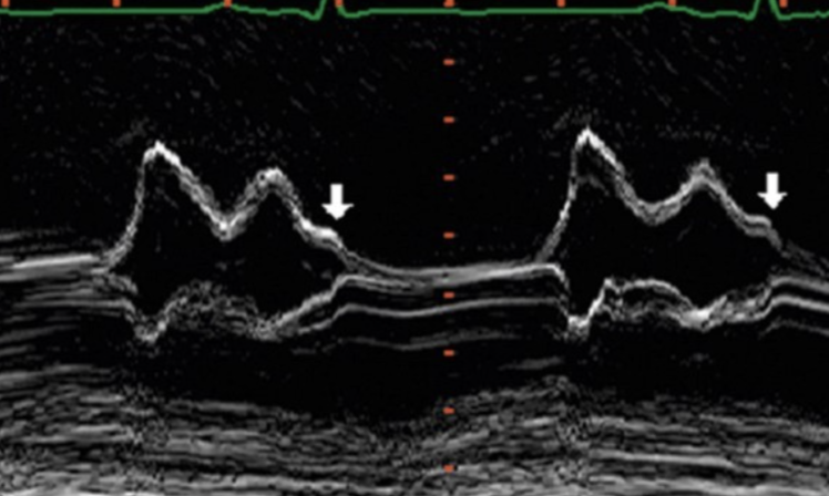 <p>elevated LV end-diastolic pressures (HFpEF)</p>
