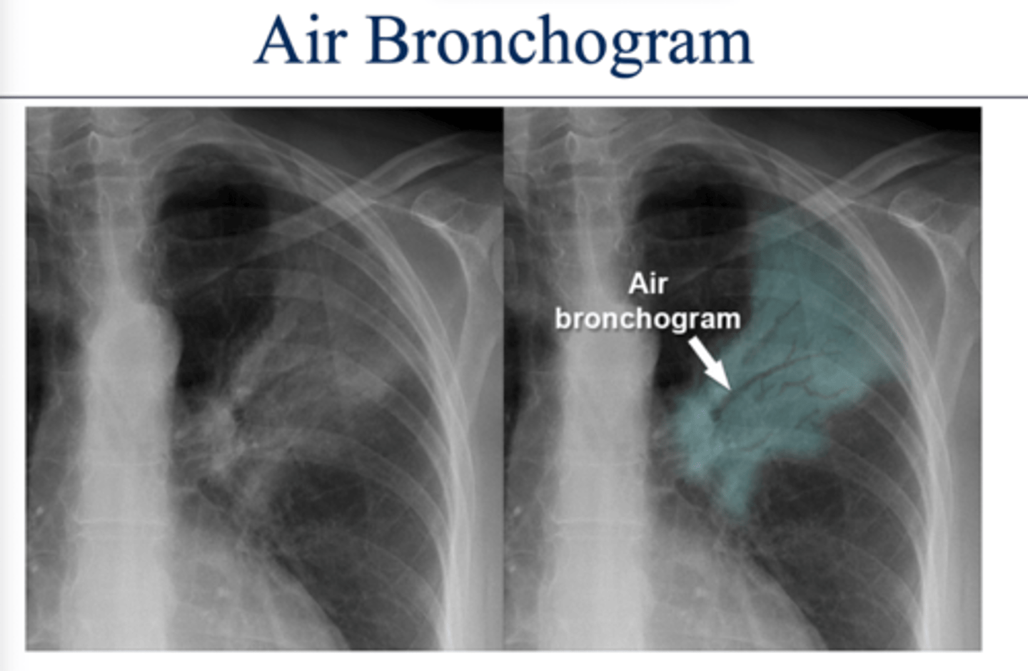 <p>Alveoli are white but bronchi remain dark creating a visible pattern</p>