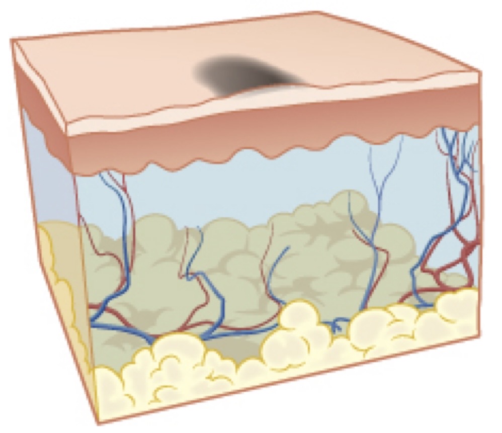 <p>Flat, smooth spot on the skin that differs in color from the surrounding area</p><p>Freckles, flat moles</p>