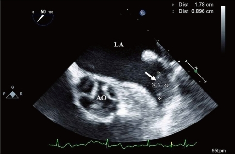 <p>The TEE image of the left atrial appendage revealed:</p>