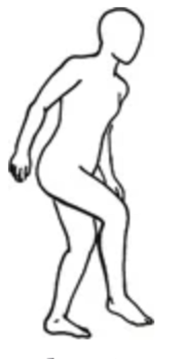 <p>- An abnormal gait in which the person lifts knee and foot high and slaps it down hard and flat to compensate for footdrop when walking up stairs</p><p>- Can be caused by weakness of tibial muscles</p>