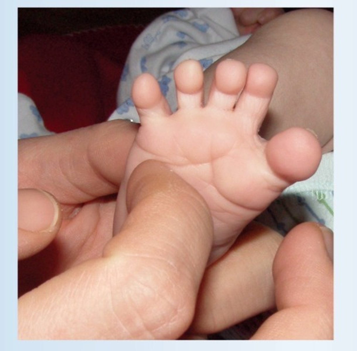 <p>stroke infant's foot up from heel to toe<br>toes should splay out<br>disappears @ 24m</p>