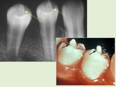 <p>Elongated “cusp” extending from central occlusal surface; mandibular premolars, maybe molars, usually has pulp tissue, problem: occlusal trauma</p>