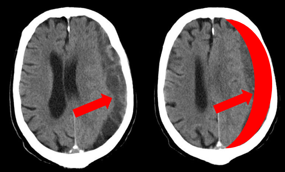 <p>tearing of vein across subdural space (______ vein) causes gradual seepage of blood and results in a _____ ________, _____ shaped </p>