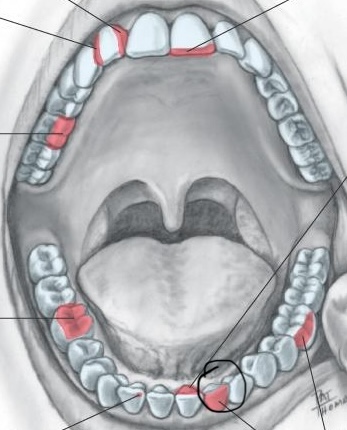 <p>Facial surface of anterior teeth closest to the lips </p>