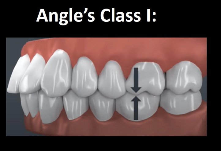<p>The MB cusp of max 1st molar is aligned directly over the buccal groove of the mand 1st molar</p>