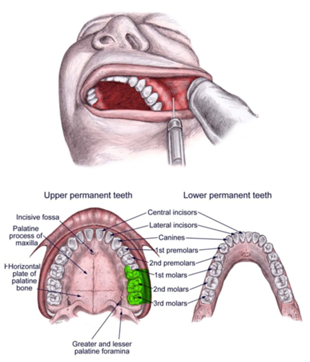 <p>Maxillary molars EXCEPT the MB root of the first molar and facial gingival tissue</p>